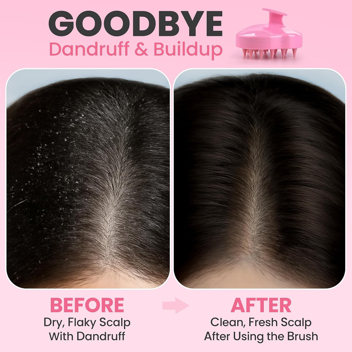 Scalp Massager Hair Growth – Exfoliator & Hair Scrubber for Scalp, Soft Bristles for Dandruff & Soothing Comfort, Shampoo Brush, Wet & Dry Use, Pink